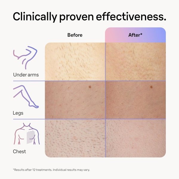 Braun IPL Long-lasting Laser Hair Removal Device for Women & Men, Skin i·Expert, at Home Hair Removal, w/ Free App, Vanity Case, Venus Razor, 3 Smart Heads, Alternative for Laser Hair Removal, PL7243 - Image 6