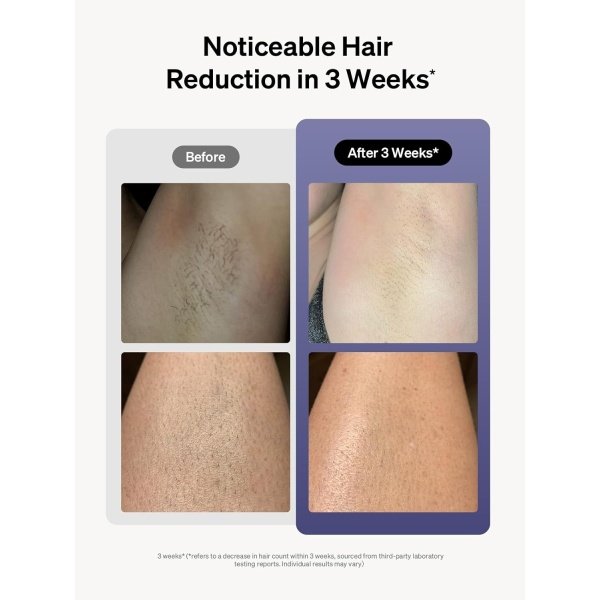 Ulike Laser Hair Removal for Women and Men, Air 3 Ice-cooling IPL Device Hair Removal for Nearly Painless & Long-Lasting Results, 3 Modes & Auto Flashing for Fast Full Body Hair Removal From Home - Imagen 4