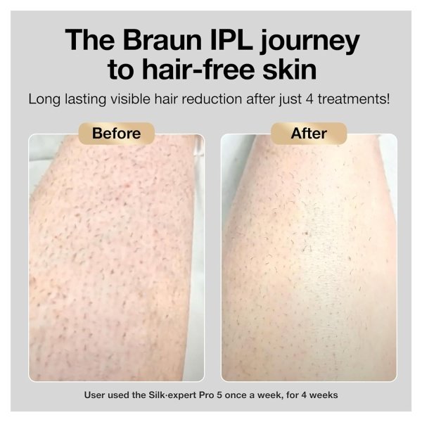 Braun IPL Long-lasting Laser Hair Removal Device for Women & Men, Silk Expert Pro5 PL5157, Safe & Virtually Painless Alternative to Salon Laser Hair Removal, Full Body, With Venus Razor & Luxury Case - Image 5